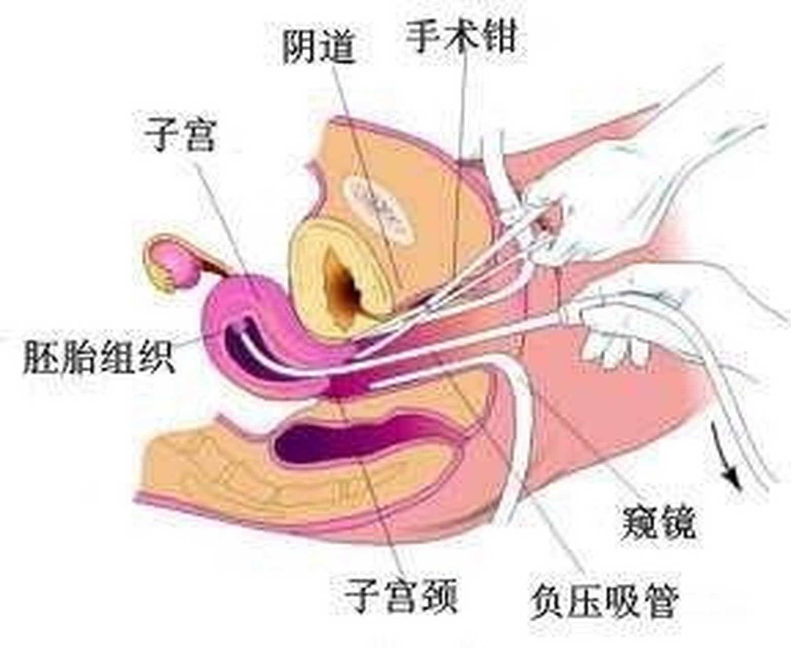 {武汉人流医院}人流手术不管是无痛人流还是有痛的普通人流,都是医生